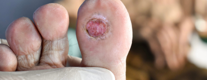 Arterial (Ischemic) Ulcers at Elegance Diabetic Foot & Ulcer Clinic (EDFC), India