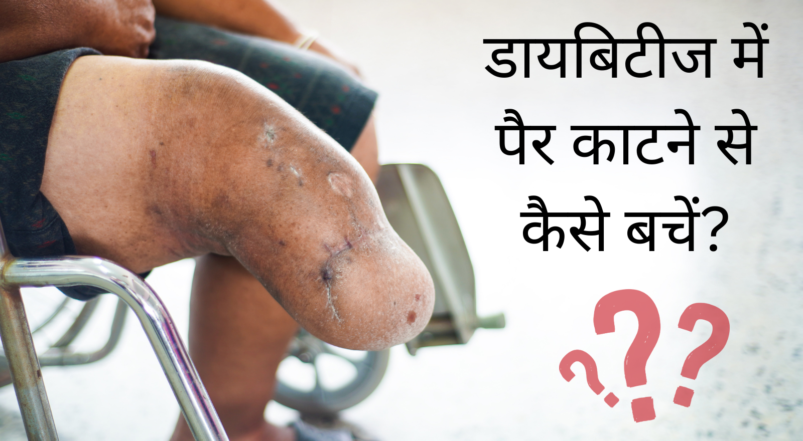 डायबिटीज में पैर काटने से कैसे बचें