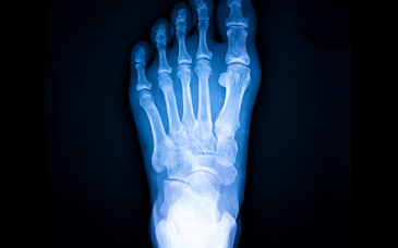 Bone Scan at Elegance Diabetic Foot & Ulcer Clinic (EDFC), India