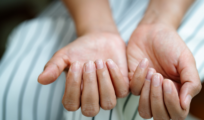 brittle nails diabetic