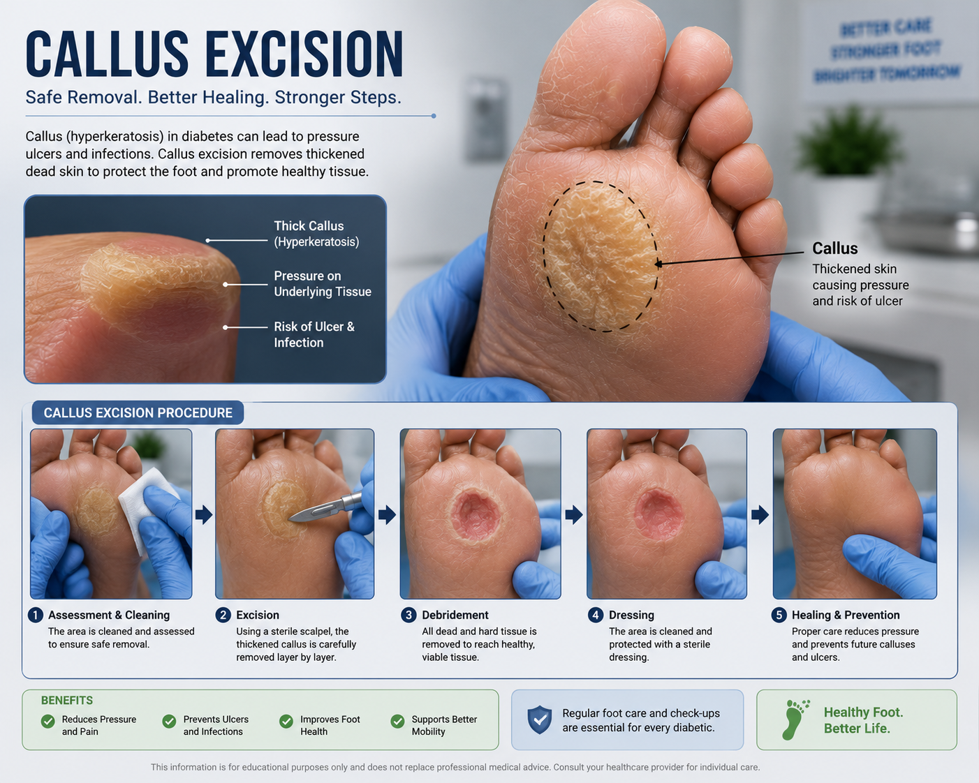 Callus Treatment in Surat: Safe Removal and Why It Matters for Diabetics