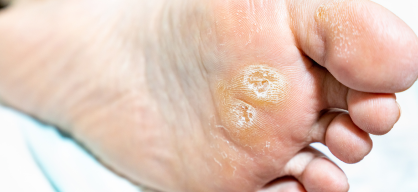 Callus treatment in India at Elegance Diabetic Foot & Ulcer Clinic (EDFC)