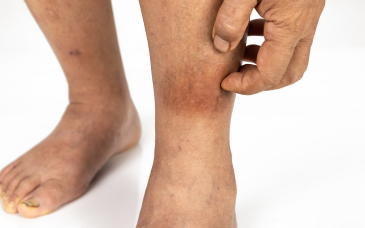Cellulitis / Abscess Management at Elegance Diabetic Foot & Ulcer Clinic (EDFC), India