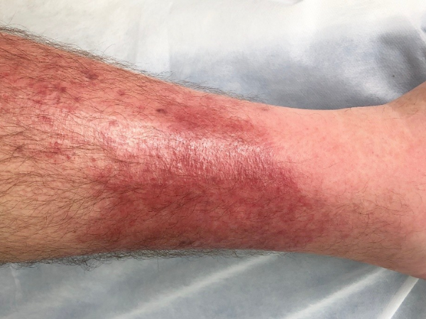 Cellulitis treatment in India at Elegance Diabetic Foot & Ulcer Clinic (EDFC)