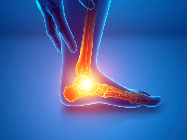 Charcot Foot treatment in India at Elegance Diabetic Foot & Ulcer Clinic (EDFC)