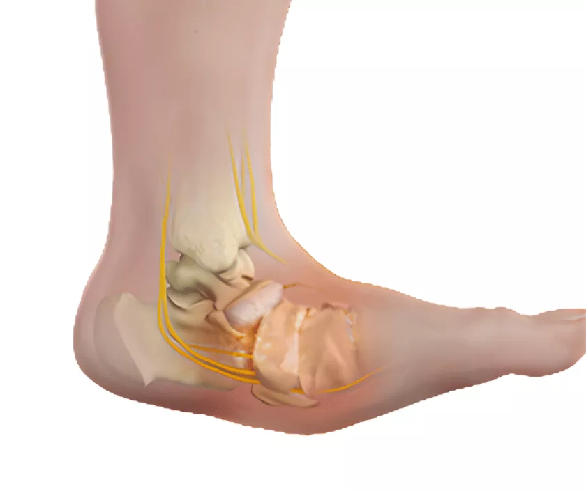 Charcot Reconstruction