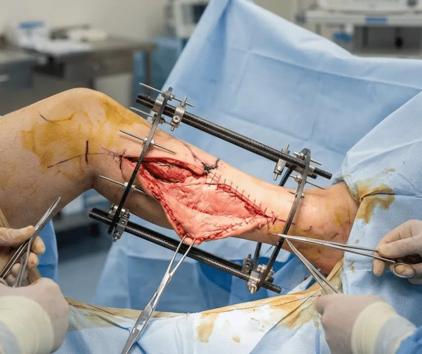 Complex Limb Salvage