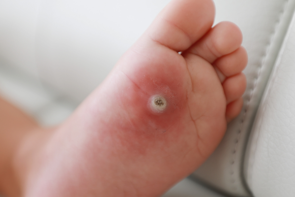 Comprehensive Foot Evaluation at Elegance Diabetic Foot & Ulcer Clinic (EDFC), India