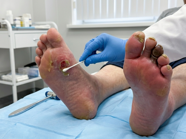 Diabetic Foot Infection treatment in India at Elegance Diabetic Foot & Ulcer Clinic (EDFC)
