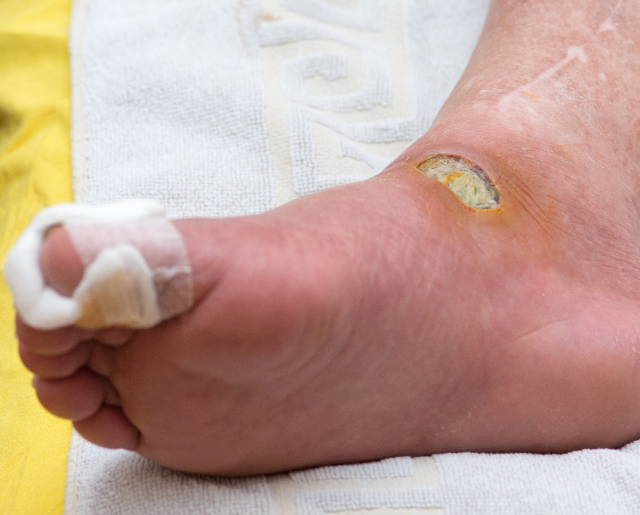 Diabetic Foot Treatment in Surat
