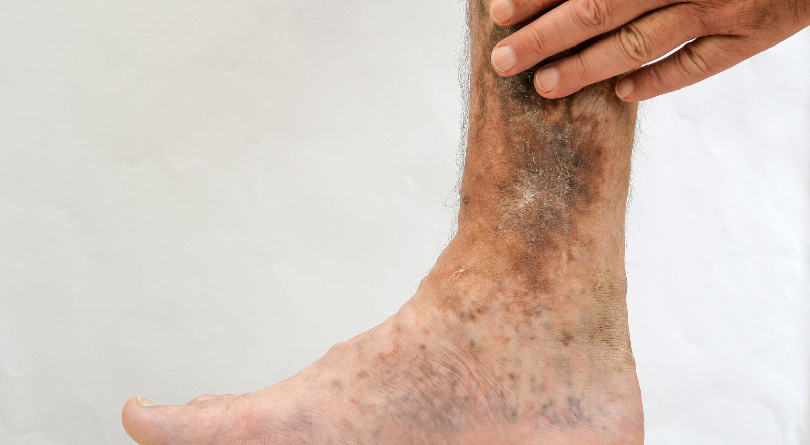 Diabetic Foot Ulcer Stages