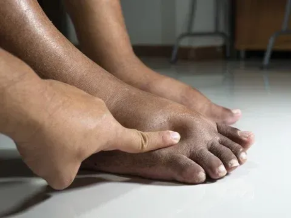 Diabetic Neuropathy treatment in India at Elegance Diabetic Foot & Ulcer Clinic (EDFC)