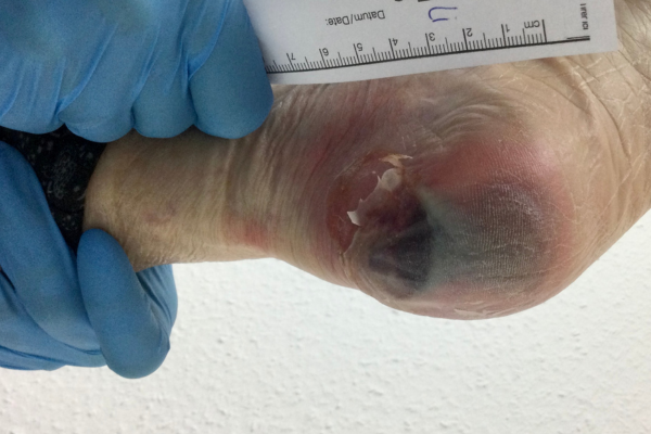Diagnostic at Elegance Diabetic Foot & Ulcer Clinic (EDFC), India