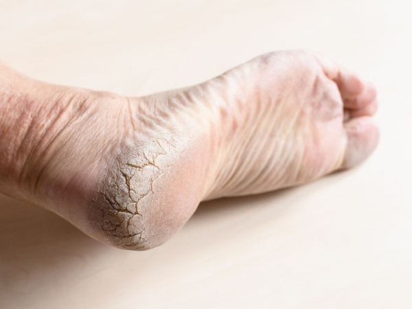 Dry & Cracked Feet treatment in India at Elegance Diabetic Foot & Ulcer Clinic (EDFC)