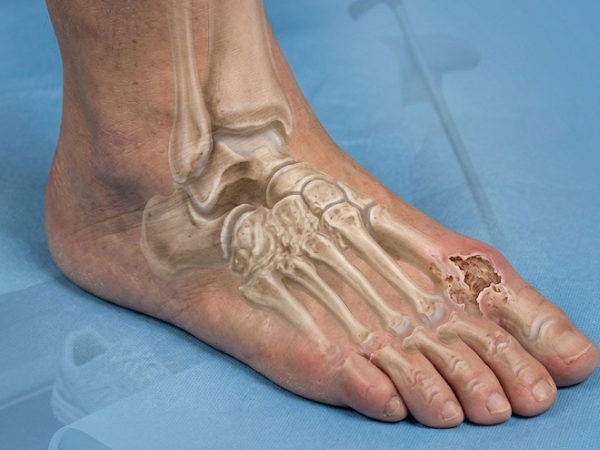 Foot Arthritis treatment in India at Elegance Diabetic Foot & Ulcer Clinic (EDFC)