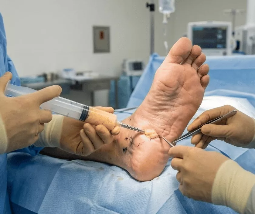 Foot Fat Grafting