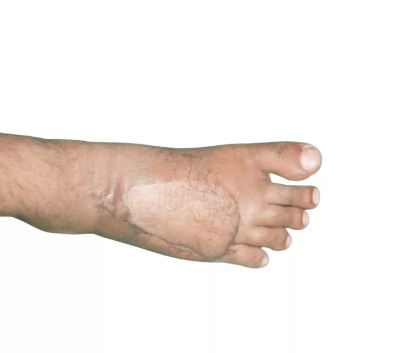 Free Flap Reconstruction