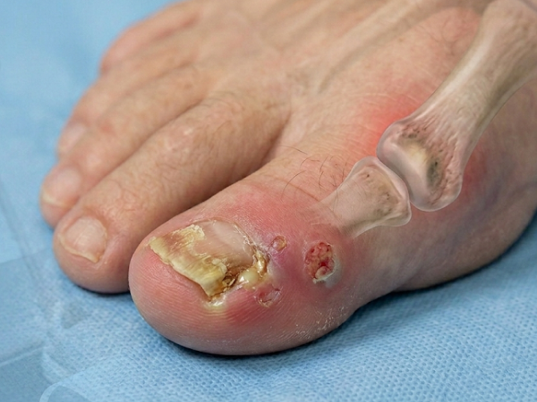 Fungal Nail Infection treatment in India at Elegance Diabetic Foot & Ulcer Clinic (EDFC)