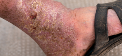 Gangrene treatment in India at Elegance Diabetic Foot & Ulcer Clinic (EDFC)