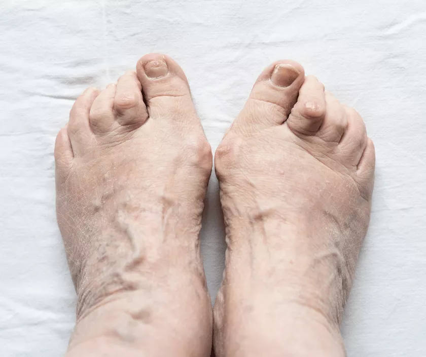Hammer Toe / Claw Toe Correction