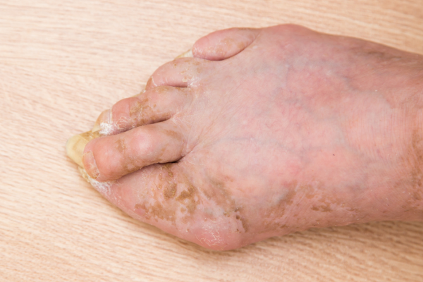 Infection Management at Elegance Diabetic Foot & Ulcer Clinic (EDFC), India