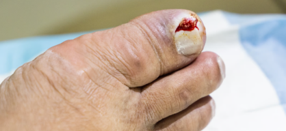 Ingrown Toenail treatment in India at Elegance Diabetic Foot & Ulcer Clinic (EDFC)