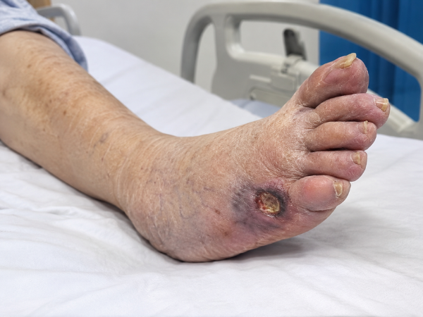 Ischemic Ulcer treatment in India at Elegance Diabetic Foot & Ulcer Clinic (EDFC)