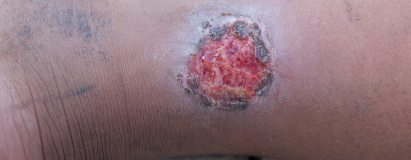 Lymphedema-Related Ulcers at Elegance Diabetic Foot & Ulcer Clinic (EDFC), India