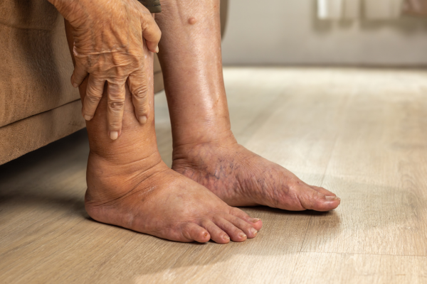 Lifestyle at Elegance Diabetic Foot & Ulcer Clinic (EDFC), India