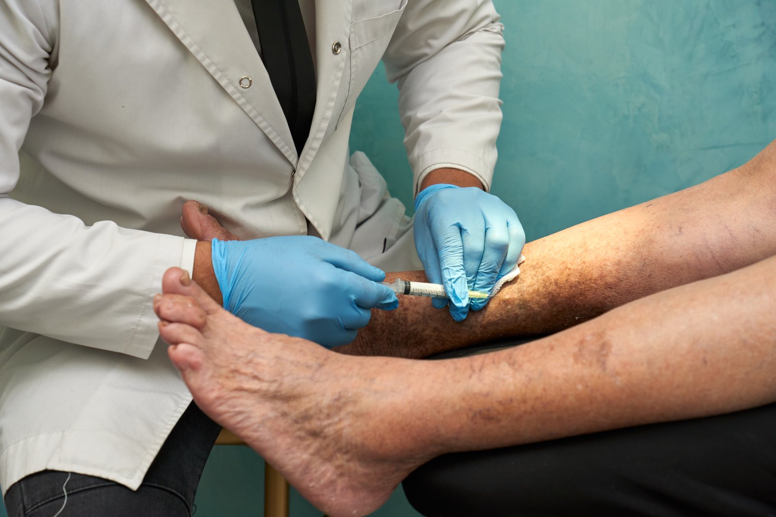 Diabetic Foot Amputation Prevention in Surat: How Feet and Limbs Are Saved