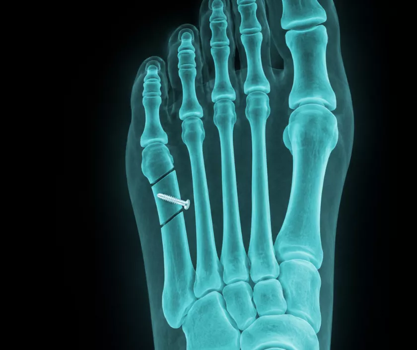 Metatarsal-osteotomy