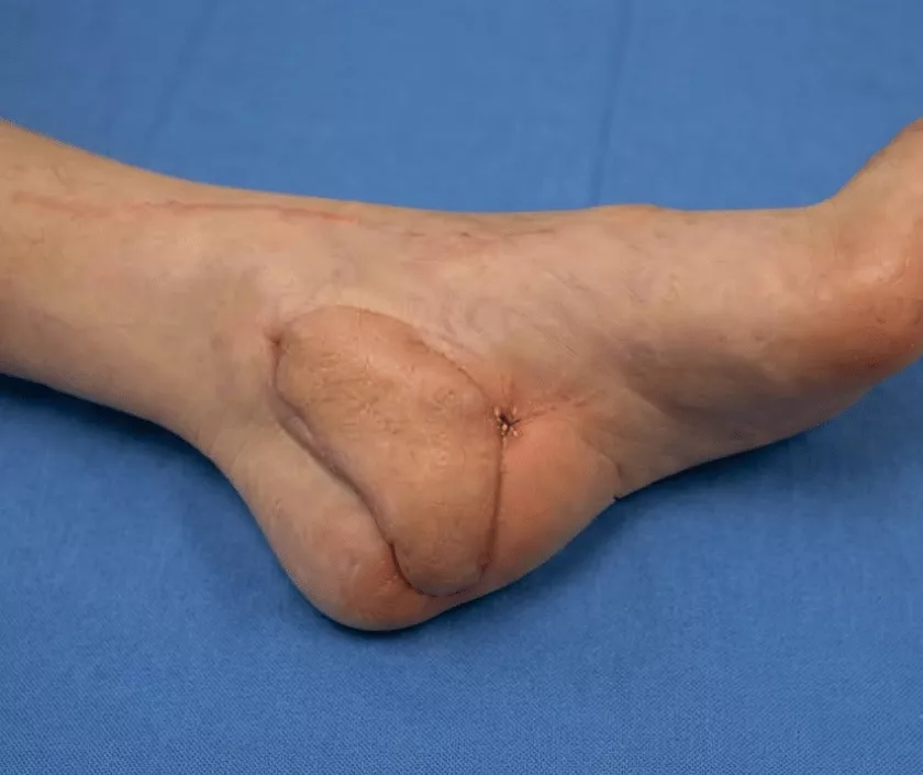 Microvascular Reconstruction