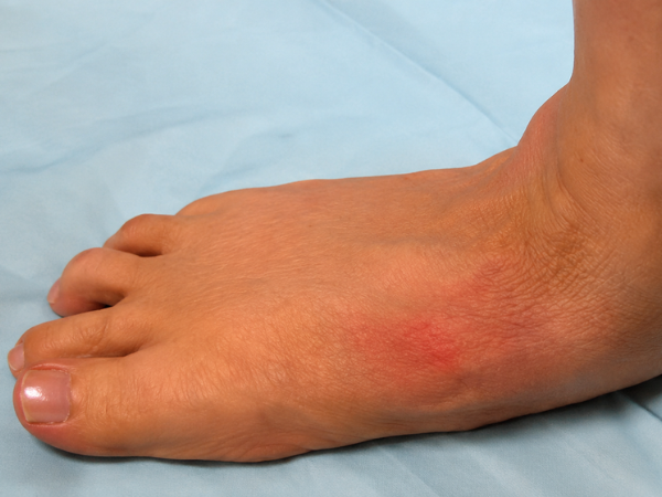 Midfoot Collapse treatment in India at Elegance Diabetic Foot & Ulcer Clinic (EDFC)
