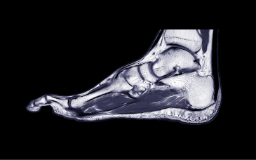 MRI Foot at Elegance Diabetic Foot & Ulcer Clinic (EDFC), India