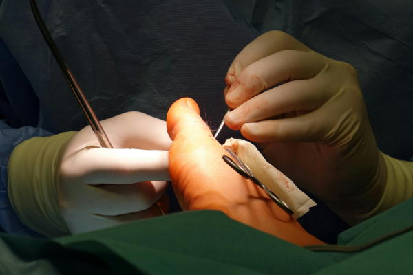 Nerve & Tendon Surgery at Elegance Diabetic Foot & Ulcer Clinic (EDFC), India