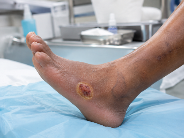 Neuro-Ischemic Ulcer treatment in India at Elegance Diabetic Foot & Ulcer Clinic (EDFC)