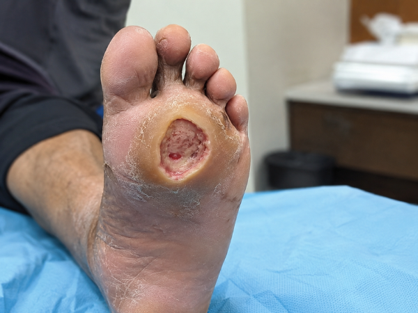 Neuropathic Ulcer treatment in India at Elegance Diabetic Foot & Ulcer Clinic (EDFC)