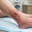 Non-healing Wounds