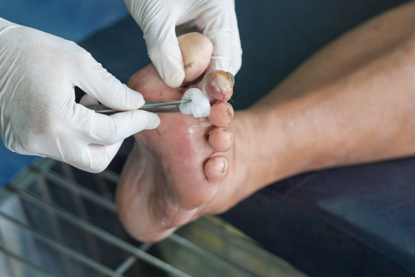 Offloading & Preventive Surgery at Elegance Diabetic Foot & Ulcer Clinic (EDFC), India