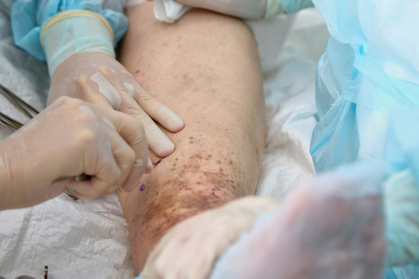 Open Vascular Surgery at Elegance Diabetic Foot & Ulcer Clinic (EDFC), India