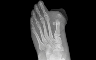 Osteomyelitis Management at Elegance Diabetic Foot & Ulcer Clinic (EDFC), India
