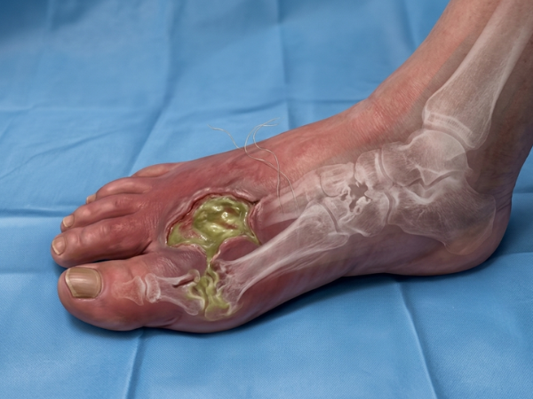 Osteomyelitis (Bone Infection) treatment in India at Elegance Diabetic Foot & Ulcer Clinic (EDFC)