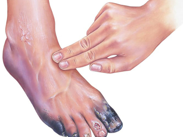 Peripheral Artery Disease (PAD) treatment in India at Elegance Diabetic Foot & Ulcer Clinic (EDFC)