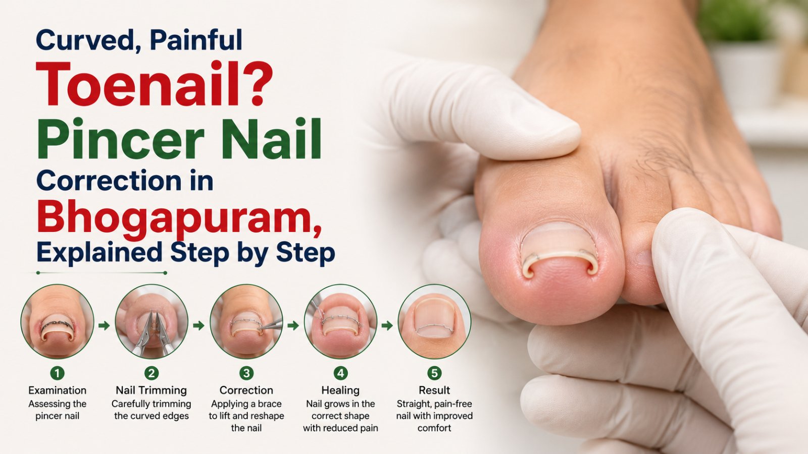 Curved, Painful Toenail? Pincer Nail Correction in Bhogapuram, Explained Step by Step