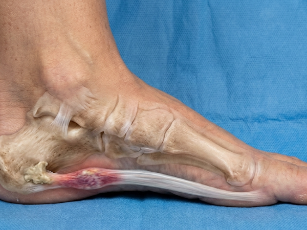 Plantar Fasciitis treatment in India at Elegance Diabetic Foot & Ulcer Clinic (EDFC)