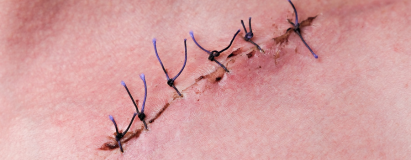 Post-Surgical (Non-Healing) Wounds at Elegance Diabetic Foot & Ulcer Clinic (EDFC), India