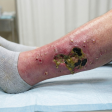 Pus or Discharge