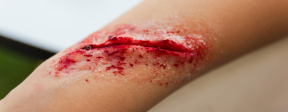 Radiation & Malignant Wounds at Elegance Diabetic Foot & Ulcer Clinic (EDFC), India