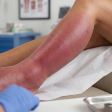 Redness or Swelling