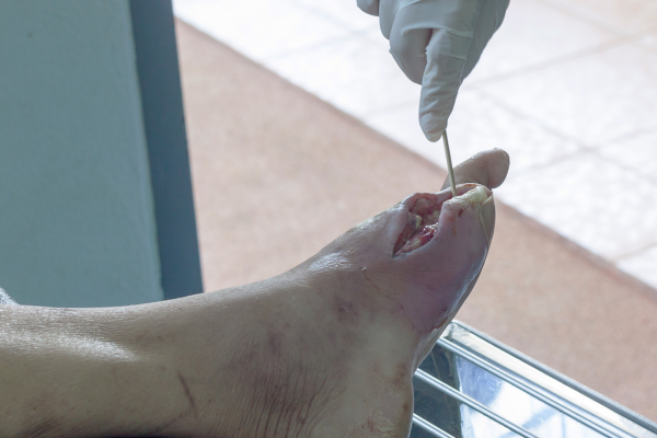 Screening at Elegance Diabetic Foot & Ulcer Clinic (EDFC), India